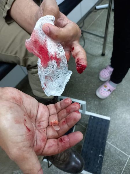 Senhor do Bonfim - BA:  Homem morde policial e arranca pedaço ( imagens fortes)